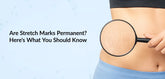 Are Stretch Marks Permanent? Here's What You Should Know