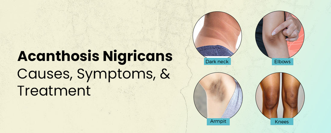 Acanthosis Nigricans