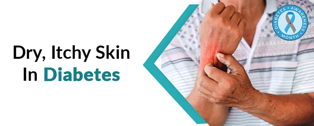Diabetes Related Skin Issues: Say Goodbye to Dryness and Itchiness