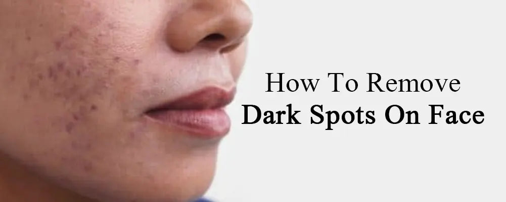 Remove Dark Spots On Face