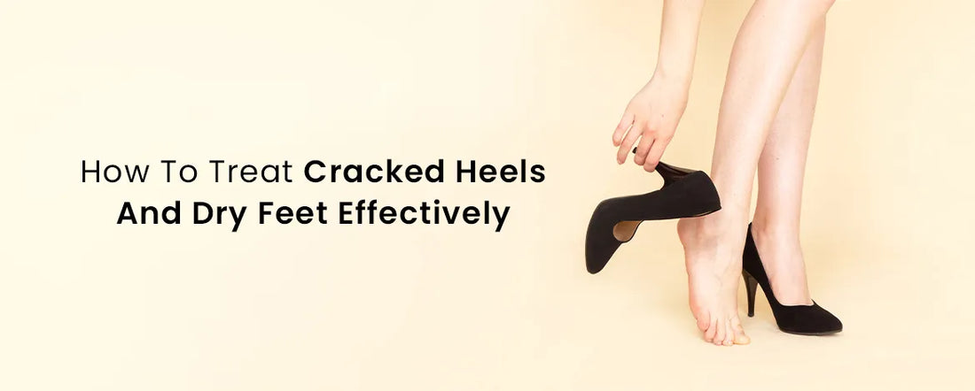 How To Treat Cracked Heels And Dry Feet Effectively
