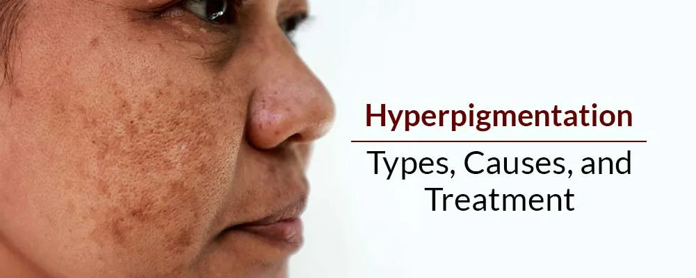 Hyperpigmentation