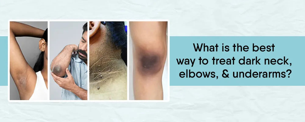 best way to treat dark neck, elbows, and underarms