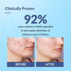 Fixderma Salyzap Acne Spot Corrector Gel