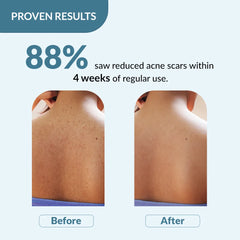 proven results of salicylic acid body wash