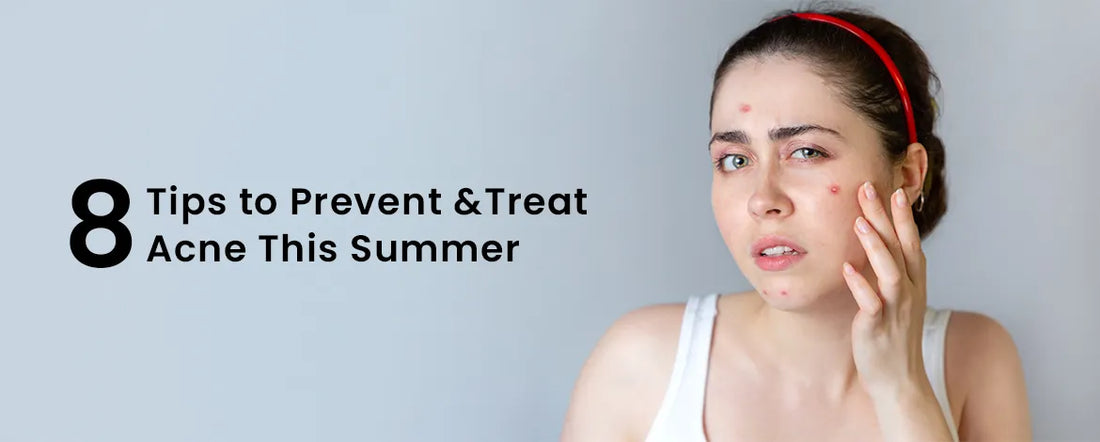 8 Tips to Prevent & Treat Acne This Summer
