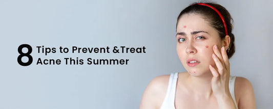 8 Tips to Prevent & Treat Acne This Summer