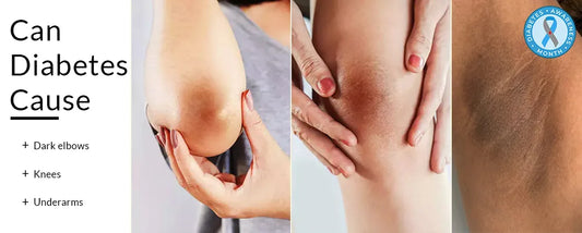 Can diabetes cause dark elbows, knees, underarms?
