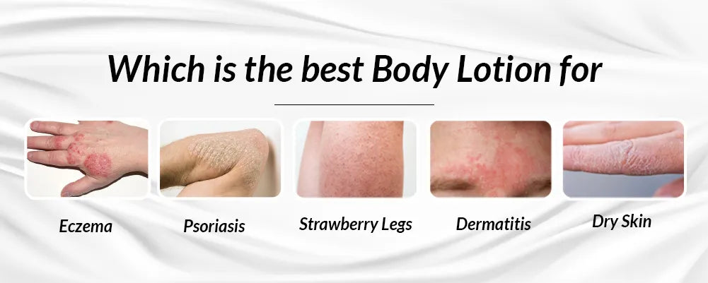 Best body lotion for eczema, psoriasis, and strawberry legs