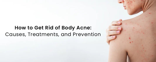 How to Get Rid of Body Acne: Causes, Treatments, and Prevention