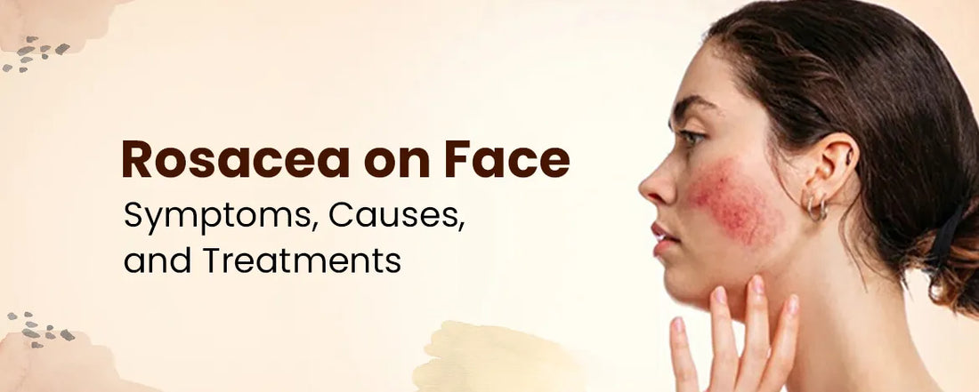 Rosacea on Face: Symptoms, Causes, Treatments