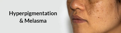 Hyperpigmentation and Melasma Treatment Products Online