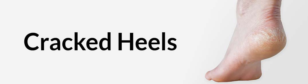Cracked Heels Treatment - Cream for Cracked Heels