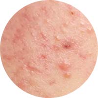 Skin care routine for acne prone skin