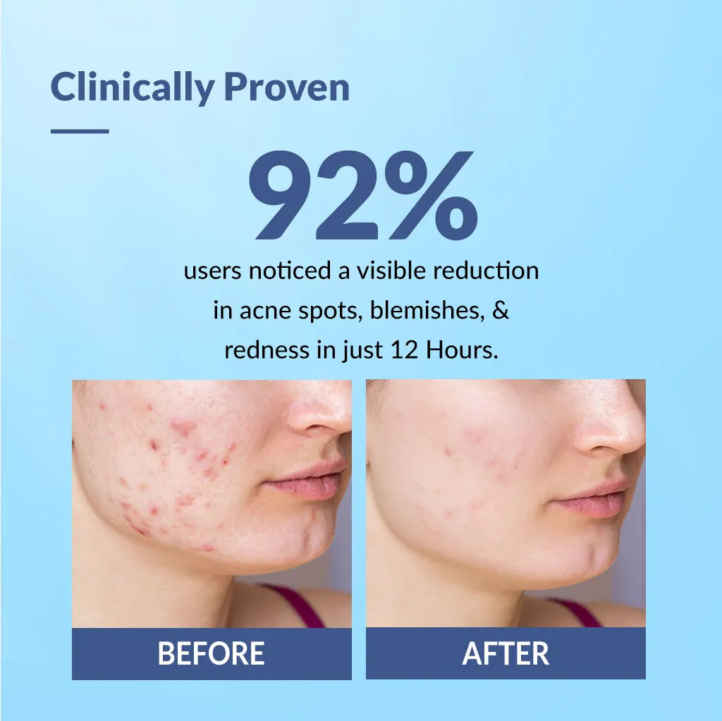 Fixderma Salyzap Acne Spot Corrector Gel