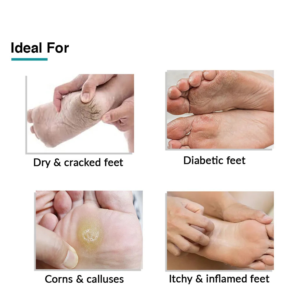 Skin Concerns] Painful, dry, cracking skin on feet. What would be the best  course of action? Specific brands, etc would be helpful. Thank you :  r/SkincareAddiction