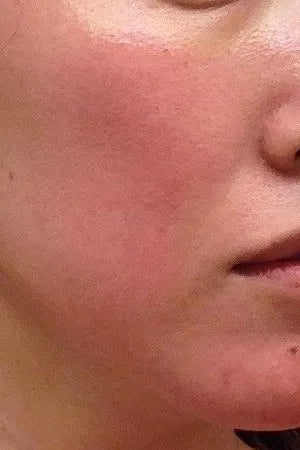 Sensitive Skin