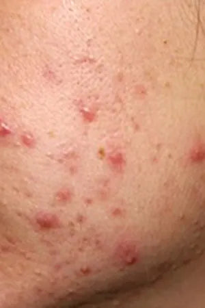 Acne Care