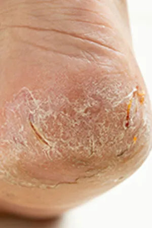 Cracked Heels