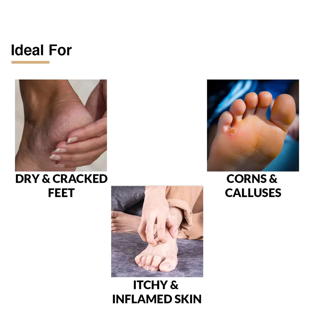5% Lactic Acid, 15% Urea, 3% Glycerine, Foot Cream for Cracked Heels