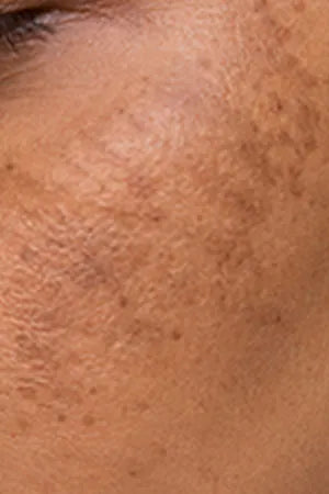 Melasma
