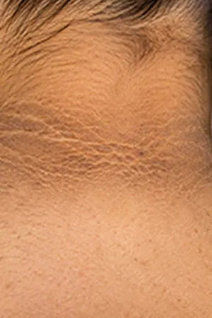 Pigmentation